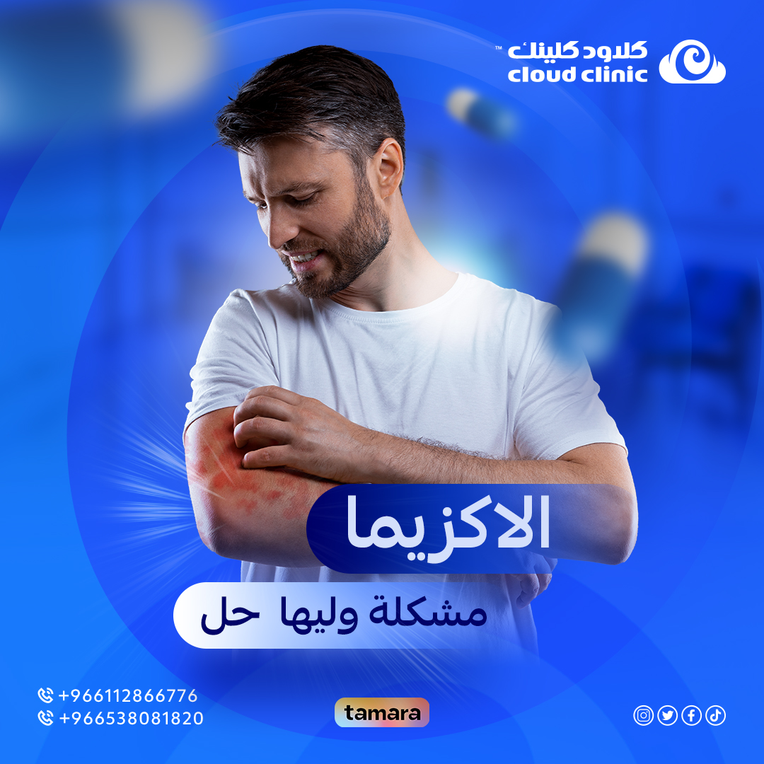 علاج الاكزيما